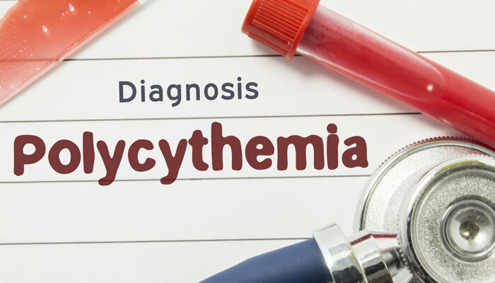 Various Aspects of Polycythemia Vera