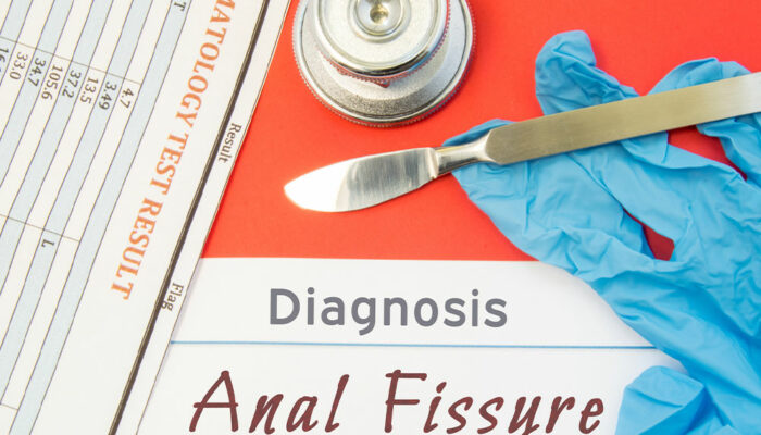 Anal Fissures &#8211; Its Causes, Symptoms, and Management