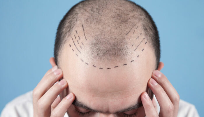 Hair Transplant &#8211; Techniques, Costs, and More