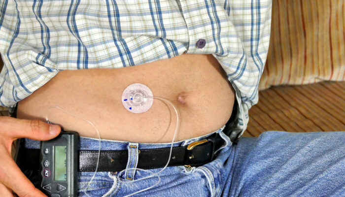 Insulin Pumps for Type 1 Diabetes &#8211; Types and Benefits