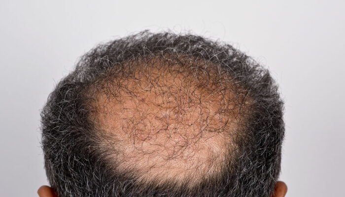 Hair Transplant &#8211; Types, Procedure, and Cost