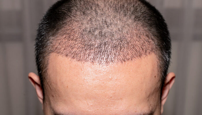 Hair Transplant &#8211; Types, Benefits, and Tips to Choose a Doctor