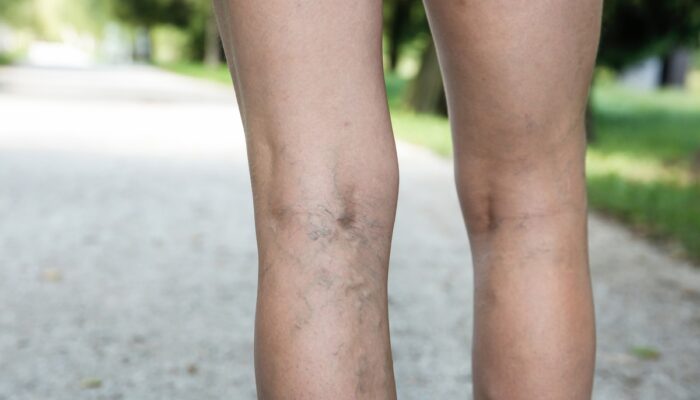 Understanding Spider Vein Treatment: Options for Clearer Skin