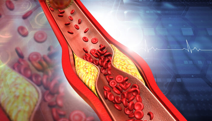 8 Ways to Manage Plaque in Arteries