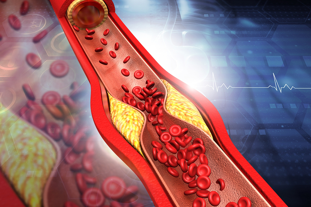 8 Ways to Manage Plaque in Arteries